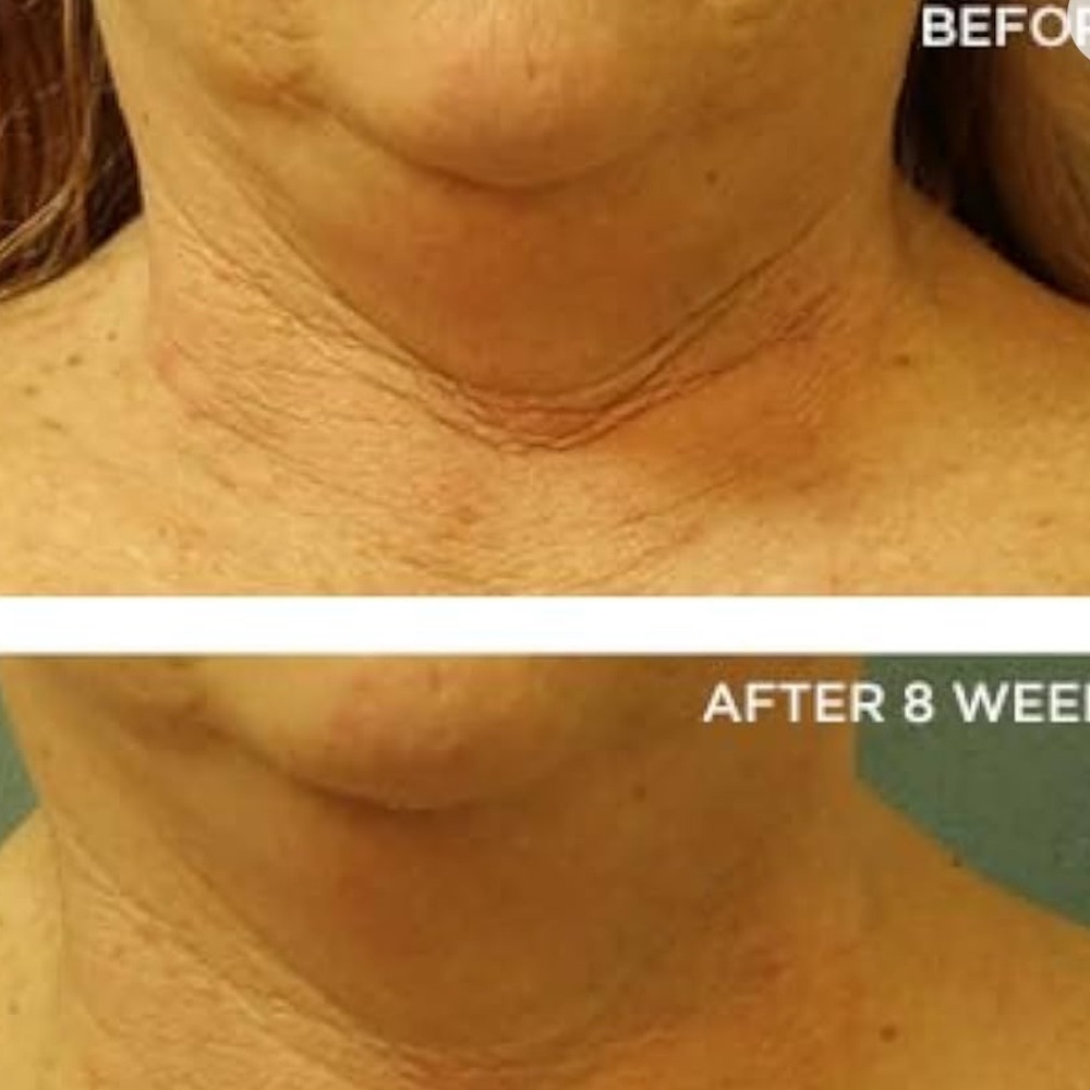 🆕 Perricone MD Cold Plasma Plus+ Neck & Chest Broad Spectrum Moisturizer spf 25 - Picture 3 of 7